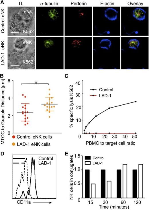 Figure 1. β2 integrin is necessary for lytic granule convergence to the MTOC in human ex vivo NK cells. All human samples were obtained after informed donor consent in accordance with the Declaration of Helsinki and were used with approval of the Institutional Internal Review Board for the Protection of Human Subjects of the Children’s Hospital of Philadelphia and/or National Institutes of Allergy and Infectious Diseases. (A) Confocal microscopy of fixed cells showing representative eNK cells from (top) a healthy donor and (bottom) a LAD-1 patient conjugated to susceptible K562 cells. After 30 minutes at 37°C on poly-L-lysine–coated glass slides (PolyPrep; Sigma-Aldrich), conjugates were fixed and stained with anti–α-tubulin (green), anti-perforin (red), and Phalloidin-F-actin (blue). TL, transmitted light. (B) Lytic granule distance from the MTOC in 15 cells; error bars show ±SD. Mean distance of lytic granules from the MTOC in LAD-1 eNK cells was significantly different from that in control eNK cells (*P < .05). (C) Standard 4-hour Cr51 cytotoxicity assay showing impaired NK cell lytic function by LAD-1 patient peripheral blood mononuclear cells (red) compared with healthy control (black). (D) Reduced CD11a expression on LAD-1 (dashed histogram) CD56+CD3− eNK cells as detected by flow cytometry compared with healthy donor control (solid histogram). (E) Conjugate formation between control (black) and LAD-1 (white) eNK cells as determined by fluorescence-activated cell sorter–based conjugation assays. Control values for each time point were normalized to 1.