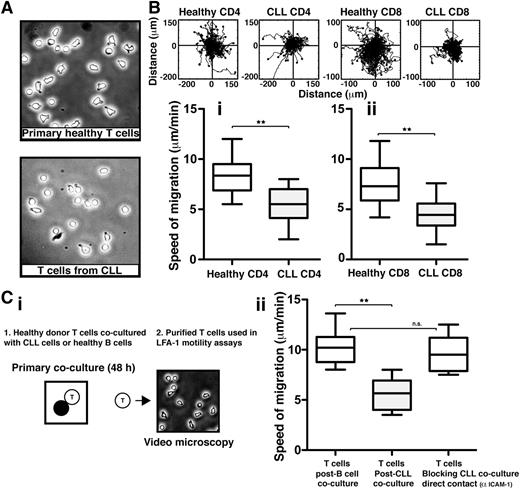 Figure 1. T cells from CLL patients exhibit impaired LFA-1 – mediated motility that can be induced in healthy T cells via direct tumor cell contact. (A) Phase-contrast images (original magnification ×20) of primary T cells isolated from age-matched healthy donors (top) and CLL patients (bottom) were allowed to adhere to immobilized CD54 ligand for 10 minutes following exposure to chemokine CXCL12. (B) Video microscopy was then used to observe the migration of (Bi) CD4 or (Bii) CD8 T cells on CD54 for 20 minutes before the migration of individual cells was tracked. Representative migratory tracks of individual T cells from healthy donors compared with those of CLL patients are shown in the upper plots (n = 40 cells per patient experiment). Box-and-whisker plots of 14 independent CLL patient migration experiments are shown in the bottom box plots. (Ci) The image shows a schematic summary of 2-part coculture functional assays. Healthy donor CD3 T cells were cocultured (48 hours) with either CLL cells (untreated or pretreated with an anti-CD54 neutralizing mAb to block CLL/T cell contact) or third-party healthy B cells (control), and then purified for subsequent migration assay analysis on CD54. (Cii) Box-and-whisker plot analysis of 14 independent CLL patient migration experiments is shown. **P < .01. ns, nonsignificant findings.