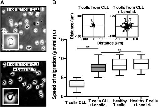 Figure 2. The immunomodulatory drug lenalidomide repairs the LFA-1 – mediated motility defect in CLL patient T cells. (A) Phase-contrast images (original magnification ×20) show untreated (top) and lenalidomide (Lenalid.) (1μM)–treated (bottom) CD3 T cells from CLL patients, which were adhering to immobilized CD54 ligand for 10 minutes following exposure to chemokine CXCL12. The enlarged image (inset) shows an individual cell from a representative experiment. Video microscopy recorded the migration on CD54 for 20 minutes before tracking and analysis. Representative migratory tracks of individual T cells from untreated compared with Lenalid.-treated CLL samples are shown in (B) the upper plots (n = 40 cells per patient experiment). (C) Box-and-whisker plot analysis of 12 independent CLL patient migration experiments is shown in the bottom box plots. **P < .01. ns, nonsignificant findings.