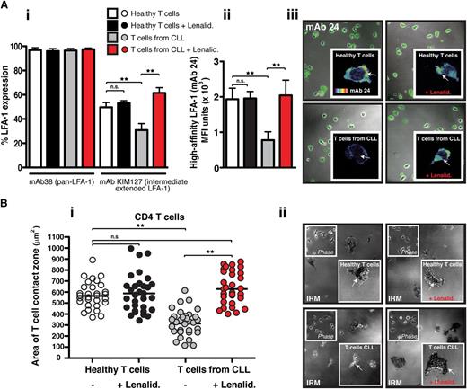 Figure 3. Lenalidomide increases extended intermediate- and high-affinity LFA-1 expression on CLL-derived T cells and rescues their firm adhesion to CD54. (Ai) The graph shows the percent of positive flow cytometric expression analysis of pan–LFA-1 (mAb 38) and the extended intermediate-affinity LFA-1 (KIM127 mAb) on chemokine CXCL12–treated suspension cells (columns show the mean ± SEM from 6 patients). (Aii) The graph shows MFI ± SD of high-affinity LFA-1 (mAb 24) immunofluorescent staining during T-cell migration on CD54 (3 independent CLL patient experiments) examining untreated or lenalidomide (Lenalid.)–treated peripheral blood CD3 T cells from CLL patients compared with age-matched healthy donor cells. (Aiii) Representative images of mAb 24 staining visualized using confocal microscopy (with Alexa Fluor 488 secondary antibody) are shown for each experimental T-cell population as indicated. The enlarged images (insets) show single-cell mAb 24 staining using a rainbow scale where yellow/red indicates strong expression and blue the weakest). (Bi) The graph shows IRM quantification of the area of close cell contact points during LFA-1–directed motility on CD54 (following chemokine stimulation) for n = 30 T cells (individual dots) per experimental population (dot plots are representative of 3 independent CLL patient experiments). (Bii) Representative cell contact points are shown in the IRM images of T cells from healthy donors (upper panels) compared with CLL patients (lower panels) who were untreated (left panels) and treated with lenalidomide (Lenalid.) (right panels). Phase-contrast images are shown (upper left insets) as are enlarged single-cell IRM images (lower right insets). Original magnification ×63.**P < .01. ns, nonsignificant findings.