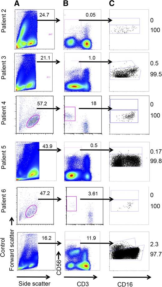 Figure 2. Reduced frequency of CD56+CD3− NK cells and enrichment of the CD56dim NK cell subset in GATA2 patients. Analysis of PBMCs from whole blood by FACS. Cells were (A) gated on lymphocytes, (B) further gated on CD56+CD3−, and (C) then analyzed for CD56 density with the aid of CD16 to identify CD56dim populations. (Bottom) One representative healthy donor control is shown.