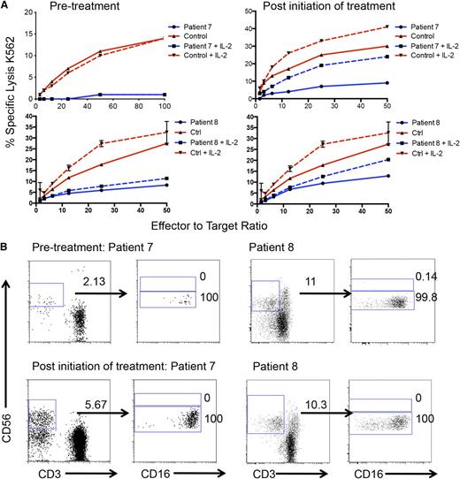 Figure 6. In vivo–administered IFNα increases NK cell numbers and functionality but does not restore CD56bright insufficiency. PBMCs were isolated from whole blood of patients 7 and 8 before and after initiation of IFNα2b treatment. (A) Patient (blue) or control (red) NK cell cytotoxicity was assayed against susceptible K562 target cells (left) before and (right) after treatment in the presence (dashed) or absence of IL-2 (solid). (B) PBMCs from whole blood were isolated and analyzed by FACS as in Figure 2 (top) before and (bottom) after treatment.