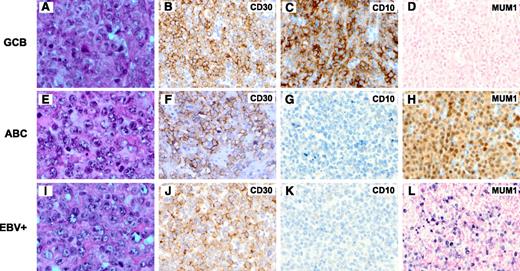 Figure 1. Morphology and immunophenotype of CD30+ de novo DLBCL. (A-D) A case of CD30+ DLBCL of the GCB subtype (panel A, H&E; panel B, CD30; panel C, CD10; and panel D, EBER in situ hybridization). (E-H) A case of CD30+ DLBCL of the ABC subtype (panel E, H&E; panel F, CD30; panel G, CD10; and panel H, MUM1). (I-L) A case of CD30+EBV+ DLBCL (panel I, H&E; panel J, CD30; panel K, CD10; and panel L, EBER in situ hybridization). Original magnification ×1000 (A,E,I) and ×500 (all others).