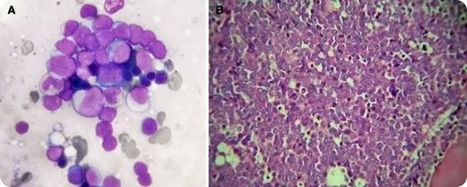 A 40-year-old man presented with severe anemia and gum bleeding. His complete blood count showed severe pancytopenia (hemoglobin, 67 g/L; red blood cells, 2.1 × 1012/L; white blood cells, 0.8 × 109/L; platelets, 12 × 109/L). The peripheral blood smears revealed no blasts or atypical cells. The bone marrow aspiration yielded a dry tap. A trephine biopsy was performed with preparation of a few touch imprints. The touch imprints were packed with blasts (panel A), which upon cytochemical staining showed myeloperoxidase positivity. An initial diagnosis of acute myeloid leukemia was made the same day. A week afterward, the trephine biopsy sections were evaluated, which showed marked hyperplasia with near-total replacement of the marrow by blasts (panel B). Immunohistochemistry confirmed the case as acute myeloid leukemia. / Bone marrow touch imprints play a crucial role in the diagnostic workup of acute leukemia, particularly when there is severe pancytopenia and a dry tap on aspiration. In few instances like this, the peripheral blood may not yield the required number of cells for flow cytometry. An adequate touch imprint provides important morphologic information to arrive at an initial diagnosis the same day while the trephine biopsy sections are awaited. The value of touch preparation is well reported in the literature but may be overlooked in practice.