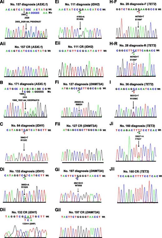 Figure 2. Electropherograms of the 10 pediatric patients with AML carrying 5 mutated genes of epigenetic regulators. Two patients with ASXL1 mutations (Ai and B), 2 patients with IDH1 mutations (C and Di), 1 patient with IDH2 mutation (Ei), 2 patients with DNMT3A mutations (Fi and Gi), and 3 patients with TET2 mutations (H-F reads forward, H-R reads reversely, I, and Ji) at diagnosis, and wild types of the 5 genes in complete remission of the corresponding patients (Aii, Dii, Eii, Fii, Gii, and Jii).