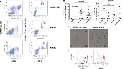 Figure 1. Increased frequency of MDSCs in patients with MM. The presence and the frequency of MDSCs were quantitated in the PB and the BM of patients with MM (Table 1) and in healthy donors by multiparameter flow cytometry. PBMCs and BMMCs were obtained from patients with newly diagnosed (n = 4), relapsed (n = 4), and relapsed/refractory (n = 9) MM, as well as from healthy donors (n = 5), and then stained for MDSCs using fluorochrome-labeled antibodies against CD11b, CD14, HLA-DR, CD33, CD15, and isotype controls. MDSCs were immunophenotyped as the CD11b+CD14-HLA-DR-/lowCD33+CD15+ population and quantitated as a percentage of gated cells by acquiring a minimum of 10 000 live events per sample. (A) Representative multiparameter dot plots of MDSCs within the CD11b+CD14-HLA-DR-/low population (gated, left) are shown as CD11b+CD14-HLA-DR-/lowCD33+CD15+ population (gated, right) in PBMCs from healthy donors (top row), as well as PBMCs (middle row) and BMMCs (bottom row) from patients with relapsed MM. (B) Shown is the frequency of CD11b+CD14-HLA-DR-/lowCD33+CD15+ MDSCs in PBMCs from healthy donors compared with PBMCs and BMMCs from patients with MM (left). The frequency of MDSCs in PBMCs from healthy donors compared with BMMCs from patients with newly diagnosed, relapsed, or relapsed/refractory MM are also shown (right). The data represent the percentage of MDSCs in PBMCs or BMMCs. Statistical significance is indicated (Student t test, 1-tailed distribution, P < .05). (C) Shown are representative cytospin images of CD11b+CD14+ myeloid cells (left) and CD11b+CD14-HLA-DR-/lowCD33+CD15+ MDSCs (right) with Wright-Giemsa staining in BMMCs from patients with relapsed MM. Photomicrographs show myeloid cells, identified by the mononuclear or polymorphonuclear cell nuclear staining (blue) using light microscopy (20 × 0.30 objective magnification) (Leica DM IL; Bannockburn, IL) and analyzed using a Leica DFC490 camera and Leica Application Suite version 2.8 software. (D) Intracellular expression of the inhibitory molecules ROS and ARG1 in MDSCs within MM-BMMCs are demonstrated by histogram plots. The x-axis represents ROS or ARG1, and the y-axis represents the number of positive cells within the MM-BMMCs. The negative control is shown (gray dotted line), as are the intracellular expression of ROS or ARG1 in CD11b+CD14+HLA-DR+ myeloid cells (blue line) and in CD11b+CD14-HLA-DR-/lowCD33+CD15+ MDSCs (red line) within BMMCs of patients with relapsed MM disease. The data shown are representative of 3 different experiments. hPB, PB from healthy donors; NewDx-MM, newly diagnosed patients; Rel-MM, relapsed patients; Rel/Ref-MM, relapsed/refractory patients.