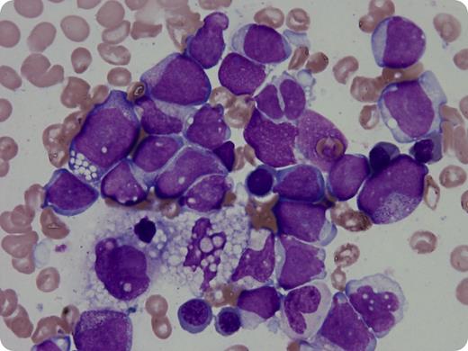 A 46-year-old man was referred for acute myelocytic leukemia (AML) and pneumonia. On admission, physical examination findings included high fever and hepatosplenomegaly. The peripheral blood count results were as follows: hemoglobin level, 7.9 g/dL; platelet count, 7 × 109/L; and white blood cell count, 17.8 × 109/L (blasts, 37%). Bone marrow aspiration showed a hypercellular marrow with 60% myeloblasts and increased activated histiocyte and hemophagocyte levels. G-banding analysis showed that these blasts had a chromosomal abnormality with inv(3)(q21q26.2). Biochemical studies showed that the lactate dehydrogenase and ferritin levels were 351 IU/L and 877 ng/mL, respectively. The levels of serum triglycerides and sodium were both normal. Coagulation analysis showed the presence of disseminated intravascular coagulation. The patient received antibiotics for pneumonia, gabexate mesilate for disseminated intravascular coagulation, and chemotherapy for AML. Although both pneumonia and coagulopathy improved within several weeks, he had prolonged severe thrombocytopenia. Many leukemic blasts and hemophagocytes were still present in the bone marrow after chemotherapy. He died of Stenotrophomonas maltophilia pneumonia during a neutropenic period after reinduction chemotherapy. Hemophagocytic syndrome did not ameliorate during the clinical course. / In hematological malignancies, malignancy-associated hemophagocytic syndrome is mostly accompanied by lymphoid neoplasms. Here, we present a rare case of this syndrome in combination with AML.