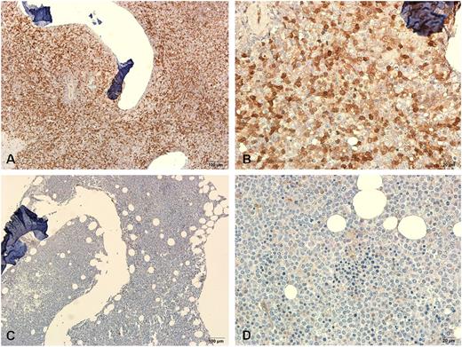 Figure 1. Representative immunohistochemical stainings of galectin-3 protein in BM biopsy specimens from two patients. One specimen from a patient with higher BM LGALS3 mRNA expression showed strong staining (A-B) and another one from a patient with lower BM LGALS3 mRNA expression showed weak staining (C-D). Magnification ×100 and ×400, respectively.