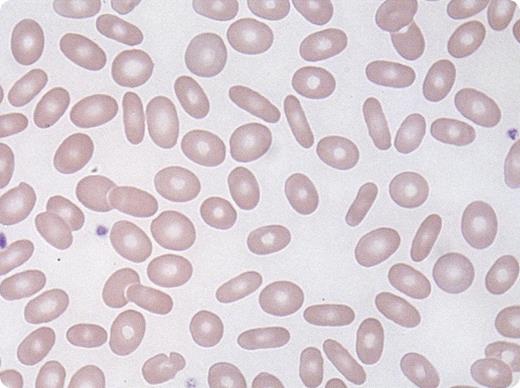 A 21-year-old African-American woman presented for routine prenatal care for her second pregnancy. Her past medical history included normocytic anemia of uncertain etiology, which was treated with iron, during her first pregnancy. At presentation, her physical examination was normal. She had a normocytic anemia (hemoglobin, 9.4 g/dL; mean corpuscular volume, 81 fL; red cell distribution width, 15.3%) with normal leukocyte and platelet counts. Routine high-performance liquid chromatography for a hemoglobinopathy was normal. A peripheral blood smear, which is routinely reviewed in all cases submitted for hemoglobinopathy testing, showed abundant elliptocytes (see figure), essentially diagnostic of hereditary elliptocytosis (HE). It appeared that a peripheral blood smear had not previously been reviewed in this patient. / HE is a heterogeneous group of disorders caused by various mutations in a number of different genes ultimately affecting red cell cytoskeleton and membrane protein integrity. Most cases of HE are due to mutations in the α-spectrin, β-spectrin, or protein 4.1 genes. Single nucleotide substitutions, insertions, deletions, and defective RNA processing have all been identified. HE is seen in numerous ethnic groups; the incidence is highest in west and central Africans. Most patients with heterozygous HE are asymptomatic, although some may demonstrate hemolytic anemia and splenomegaly. This report demonstrates the need for review of the smear in any case of anemia diagnosis. This is especially important at the time of pregnancy, as infants born to a mother with HE may develop significant neonatal hemolytic anemia and hyperbilirubinemia, occasionally with a clinical phenotype indistinguishable from hereditary pyropoikilocytosis.
