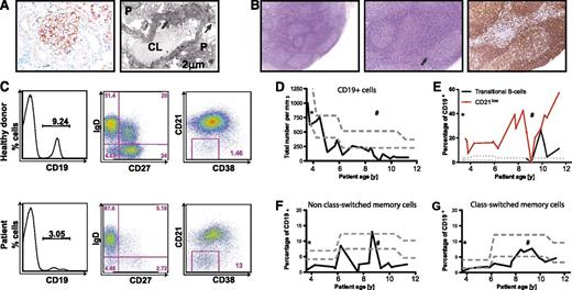 Figure 1. Clinical and immunological characterization of the index patient. (A) First renal biopsy was performed at the age of 15 months. Granular deposition of IgG along the periphery of the capillary loops (left) as seen in membranous nephropathy (MGN) was confirmed by transmission electron microscopy (TEM) (right), which showed electron dense deposits between basement membrane and podocytes (P), as well as deposits partially in resolution and incorporated by basement membrane material (arrows), consistent with MGN stage I to III (CL, capillary loop). (B) Histopathological analysis of a lymph node biopsy revealed unspecific, reactive follicular hyperplasia (arrow) but not the characteristic lymph node changes of autoimmune lymphoproliferative syndrome (ALPS) associated with CD95/FAS mutations (ALPS type 0/1a). The left and middle panels show hematoxylin and eosin stains, and the right panel shows anti-CD20 staining. (C) Representative FACS plots illustrating the aberrant B-cell phenotype including B-cell lymphopenia, decreased IgM- and IgG memory B cells, and increased numbers of CD21low B cells. (D) Longitudinal analysis illustrates progressive decrease of CD19+ B cells and (E-G) persistence of the aberrant distribution of B-cell subsets. *First episode of nephrotic syndrome. #Treatment with anti-CD20. The dotted lines indicate the age-related 25th and 75th percentiles of the corresponding cells.23