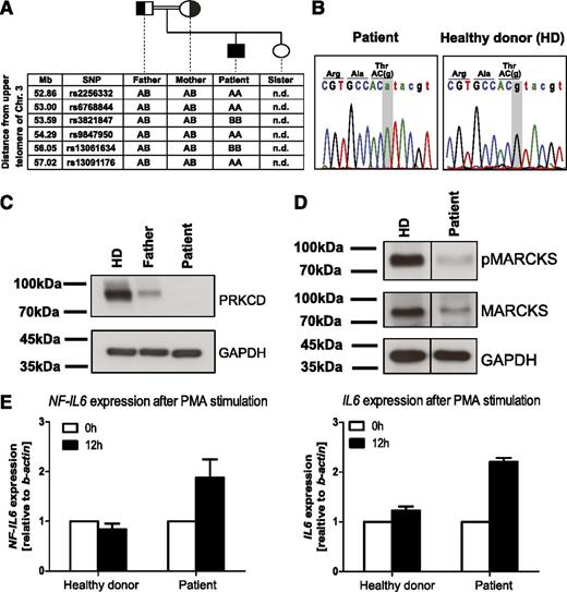 Figure 2. Identification of human PRKCD deficiency as a monogenetic B-cell deficiency associated with autoimmunity. (A) Single nucleotide polymorphism array–based homozygosity mapping was performed and revealed several homozygous candidate intervals, including an interval on chromosome 3p21.31. (B) Sanger sequencing validated a splice site mutation in PRKCD, encoding for protein kinase C δ which was homozygous in the patient. (C) Western blot analysis showed absent expression of the corresponding protein product in the patient compared with decreased expression in the heterozygous father and normal expression in a healthy control. (D) Western blot analysis showed defective phosphorylation of MARCKS, a downstream target of PRKCD. (E) Quantitative polymerase chain reaction analysis showed hyperactive NF-IL6 signaling on stimulation using phorbol myristate acetate, as indicated by increased mRNA levels of NF-IL6 and IL6.