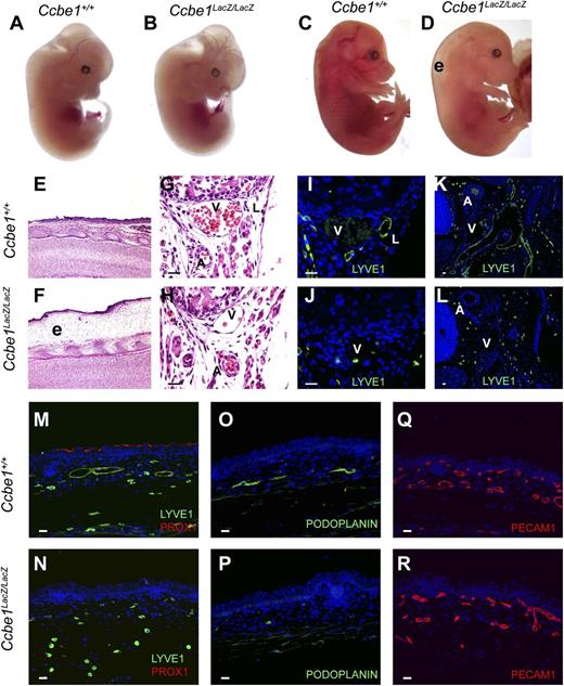 Figure 1. Ccbe1lacZ/lacZ embryos develop severe edema associated with a complete lack of lymphatic vessels. (A,B) E12.5 Ccbe1lacZ/lacZ embryos appear indistinguishable from wild-type littermates. (C,D) Severe cutaneous edema (“e”) is present in E16.5 Ccbe1lacZ/lacZ embryos. (E,F) Edema is revealed by H&E staining of skin from the E16.5 Ccbe1lacZ/lacZ and control embryos shown in panels C and D. (G-P) Ccbe1lacZ/lacZ embryos lack lymphatic vessels. (G,H) H&E staining of sagittal sections reveals a typical cluster of subcostal vessels including an artery (“A”), vein (“V”), and lymphatic (“L”) in an E16.5 wild-type embryo but the subcostal lymphatic is absent in a Ccbe1lacZ/lacZ littermate. (I,J) Anti-LYVE1 immunostaining confirms the absence of subcostal lymphatic vessels in an E16.5 Ccbe1lacZ/lacZ embryo. (K,L) Anti-LYVE1 immunostaining reveals a well-developed network of large lymphatic vessels adjacent to the carotid artery (“A”) and cardinal vein (“V”) in a transverse section from an E15.5 wild-type embryo, but none are present in a Ccbe1lacZ/lacZ littermate. (M-P) Immunostaining for LYVE1, PROX1, and PODOPLANIN identifies lymphatic vessels in the skin of an E16.5 wild-type embryo but not in a Ccbe1lacZ/lacZ littermate. Note the presence of LYVE1+;PROX1− cells that are likely to be tissue macrophages. (Q,R) CCBE1-deficient embryos have normal blood vessel growth. Platelet endothelial cell adhesion molecule staining of E16.5 wild-type and Ccbe1lacZ/lacZ littermate embryo skin is shown. The reduced number of total vessels in the Ccbe1lacZ/lacZ skin sample reflects the loss of lymphatic vessels. Scale bars indicate 20 μm. PECAM1, platelet endothelial cell adhesion molecule.