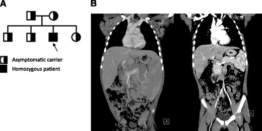 Figure 1. Clinical, immunological, histopathological, and characterization of patient. (A) Pedigree of patient. Parents do not have any known consanguinity. All 3 unaffected children and both parents are heterozygous for the same point mutation in PRKCD, whereas the patient represents the only affected offspring who is homozygous for this change. (B) Coronal computed tomography scan images illustrate massive hepatosplenomegaly and mediastinal, axillary, inguinal lymphadenopathy before treatment (left) and after treatment (right).