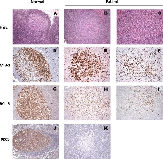 Figure 2. Histopathology of the patient lymph node as compared with a reactive node from an otherwise-healthy node. (A) H&E stain reactive follicle with polarized germinal center and mantle; (D) IHC for MIB-1: the proliferating lymphoid cells within the germinal centers are positive with polarization (dark zone); (G) IHC for BCL-6 (the master regulator of the GC formation): the entire reactive germinal center is positive for BCL-6. (J) IHC stain for PKCδ showing diffusely positive cytoplasmic stain. All the remaining photos are from the lymph node biopsy from our patient: (B) and (C) H&E stains of follicles with varying degree of ill-defined germinal center lacking mantles. (E) and (F) IHC for MIB-1: variable degree of proliferation in different germinal centers is seen with lack of polarization. (H) and (I) IHC for BCL-6: a relative small number of positive cells are present within each germinal center in comparison with the reactive follicle. (K) Absence of PKCδ stain in patient’s lymph node, compared with (J).