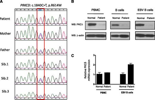 Figure 3. Identification of PKCδ mutation and protein expression. (A) Sequencing of PRKCD with genomic DNA from blood from the index patient, parents, and 3 siblings. (B) Immunoblot analysis of PKCδ and of the control protein β-actin in the cells from the patient and normal volunteer. Purified B cells were activated with F(ab′)2 specific for IgM (10 μg/mL), IL-4 (50 ng/mL), and CD40 ligand (10 μg/mL) for 5 days, and then cell lysates were subjected to western blot (WB) analysis. The protein lysates from PBMCs and EBV-transformed B cells were used without stimulation. (C) PRKCD gene expression levels in the PBMCs and EBV-transformed B cells are expressed as a relative expression of normal cells. Data are represented as means ± SE of n = 3 separate experiments.