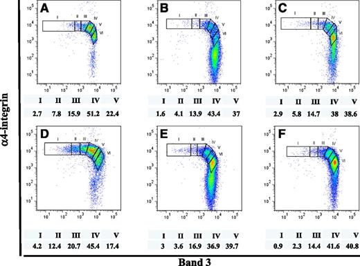 Figure 6. Terminal erythropoiesis profiles of primary human bone marrow cells from MDS patients. CD45- cells isolated from primary human bone marrow of 6 MDS patients, each with a different MDS subtype, were stained and analyzed, as described in Figure 5. Proportions of distinct stages of erythroblasts, after normalization based on total nucleated erythroid cells as 100%, are indicated. Panels A, B, C, D, E, and F show the terminal erythropoiesis profile of the MDS subtype refractory anemia, refractory anemia with ringed sideroblasts, refractory cytopenia with multilineage dysplasia, refractory cytopenia with multilineage dysplasia and ringed sideroblasts, refractory anemia with excess blasts-1, and refractory anemia with excess blasts-2, respectively. (I) proerythroblasts; (II) early basophilic erythroblasts; (III) late basophilic erythroblasts; (IV) polychromatic erythroblasts; and (V) orthchromatic erythroblasts.