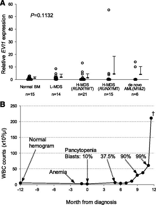 Figure 1. EVI1 overexpression collaborates with RUNX1 mutations in human MDSs. (A) EVI1 expression levels by qRT-PCR in CD34+ cells of clinical samples. Relative EVI1 expression was calculated as the ratio of EVI1 to GAPDH expression. RNA from normal BM CD34+ cells served as a control, and the RNA level was defined as 1. Data are expressed as mean ± standard deviation (SD). L-MDS, lower-risk MDS; H-MDS, higher-risk MDS; MT, mutation. (B) White blood cell (WBC) count and clinical course of a patient with high EVI1 expression. A 78-year-old male showed pancytopenia and blast cells in peripheral blood. BM examination showed hypocellular marrow with multilineage dysplasia and 16.5% of blast cells. Cytogenetic analysis showed 45,XY,add(3)(q13.2),-7. He was diagnosed with refractory anemia with excess blasts (RAEB-2) and received chemotherapy. However, his condition progressed to BM failure after chemotherapy and repeated severe infection. The blast population continued to increase gradually. Eight months after diagnosis, his WBC count started to increase, and he died with uncontrollable blast expansion 11.5 months after diagnosis.