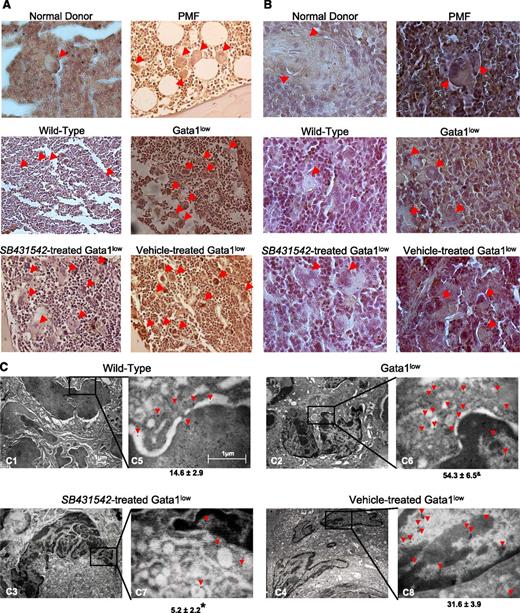 Figure 1. The TGF-β1 content of MKs from PMF patients and Gata1low mice is similarly increased. (A-B) TGF-β1–specific immunohistochemistry of representative BM (A) and spleen (B) sections of one nondiseased donor and one PMF patient, untreated wild-type, or Gata1low mice, and Gata1low mice treated with either SB431245 or vehicle, as indicated. Arrows indicate representative MKs. Human MKs are on average twice as large as murine MKs. Original magnification ×20 (A) and ×40 (B). Quantifications of MK frequency and intensity of TGF-β1 immunostaining for the different groups are presented in Table 1. (C) TGF-β1 immunogold-staining of one representative MK (C1-4) from untreated wild-type and Gata1low mice and from Gata1low mice treated with either SB431245 or vehicle. The selected areas of the MK cytoplasm indicated by rectangles are shown at a higher magnification in C5-8. Arrowheads indicate TGF-β1–specific gold particles. The mean (±SD) number of immunogold-particles/14 μm2 of MK cytoplasm obtained in 5 replicate measurements is indicated below each panel. Values statistically different (P < .05) between untreated wild-type and Gata1low mice and vehicle- and SB431542-treated Gata1low mice are indicated by & and *, respectively. Magnification ×4400 in C1-4 and 30 000× in C5-8.