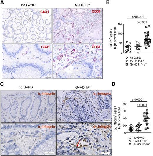 Figure 5. Neovascularization and αv integrin expression are features of human GvHD. (A) Representative sections of the IT are shown for patients with or without GvHD. The panels show red immunohistochemical staining for CD31 in the microvasculature. (B) The immunohistochemical analysis for CD31 in the IT of healthy and GvHD patients is shown. CD31 expression is increased in patients with GvHD III°-IV° compared with GvHD I°-II° (P = .001) or patients without GvHD (P = .0001). (C) Histopathological analysis for αv integrin in the IT of patients with or without GvHD. αv Integrin expression is preferentially found in ECs of patients with GvHD with brown immunohistochemical staining for αv integrin in the microvasculature. Representative sections of the IT are shown for healthy and GvHD patients. (D) The immunohistochemical analysis for αv integrin in the IT of healthy and GvHD patients is shown with an increase of αv integrin expression in patients with GvHD III°-IV° compared with GvHD I°-II° (P < .001) or patients without GvHD (P < .0001).
