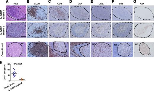 Figure 4. IL-12Rβ1–deficient subjects altered GC responses. Alteration of GC formation in IL-12Rβ1–deficient subjects. Immunohistochemistry staining of peripheral LN samples from IL-12Rβ1–deficient subjects and tonsil samples from control subjects. Samples were stained with (A) H&E, (B) CD20 mAb, (C) CD3 polyclonal Ab, (D) CD4 mAb, (E) CD57 mAb, (F) Bcl-6 mAb, and (G) AID mAb. T-B cell aggregates in subjects 1 and 2 are indicated by dotted lines. In control tonsils, secondary follicles are indicated by dotted lines, and the solid lines indicate the border between the mantle zone (MZ) and the GC. Bar equals 100 μm. (H) CD57+ cells per T-B cell aggregates. CD57+ cells were counted within the T-B cell aggregates in subject 2 LNs, and within GCs with a similar size present in tonsils from 3 control subjects. Student t test.