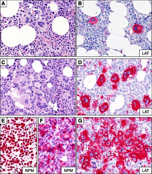 Figure 7. Megakaryocytes expansion in BM biopsy of NPM1-mutated AML patients. (A-B) Representative BM sections from a nonleukemic control were stained with (A) hematoxylin and eosin and (B) an anti-LAT antibody. (C-D) BM trephine sections from an NPM1-mutated AML patient with an increased number of megakaryocytes (∼20 megakaryocytes ×40 field) as assessed by (C) hematoxylin and eosin and (D) immunostaining for human LAT. (E) Nucleus-restricted NPM1 expression in a representative NPM1-unmutated AML patient. (F) Aberrant cytoplasmic expression of NPM1 in dysplastic megakaryocytes (original magnification, ×40) of an NPM1-mutated AML patient. (G) LAT positive megakaryocytes in a representative NPM1-mutated AML patient with a megakaryocytes concentration >40 per ×40 field (original magnification, ×40).