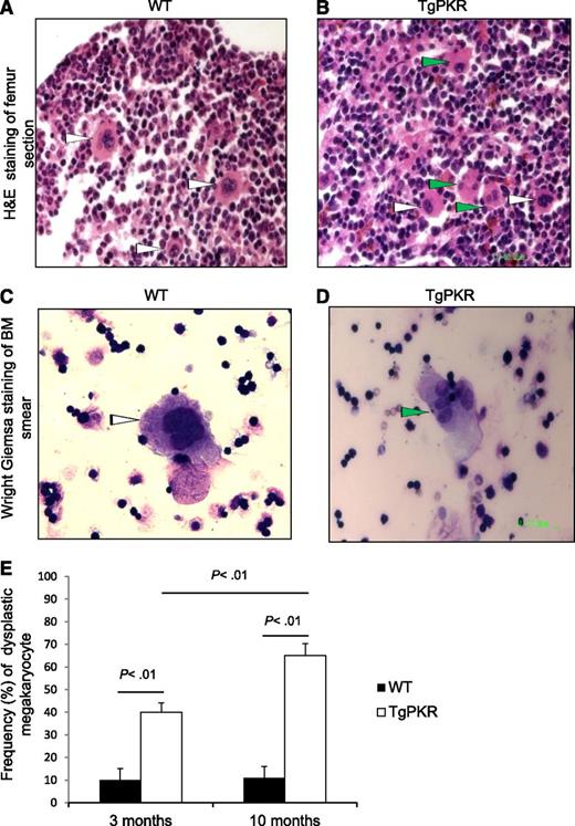 Figure 2. Transgenic expression of PKR induces BM dysplasia in TgPKR mice. (A and B) Hematoxylin and eosin (H&E) staining of paraffin-embedded sections of femur (for BM) from WT control and TgPKR mice as indicated. White arrows point to normal megakaryocytes. Green arrows indicate dysplastic megakaryocytes with single nuclear lobe or with multiple separated nuclear lobes. (C and D) Wright-Giemsa staining of BM smears from WT control or TgPKR mice as indicated. White arrows indicate normal megakaryocytes. Green arrow indicates a dysplastic megakaryocyte with multiple separated nuclear lobes. (E) Graph showing percentage of dysplastic megakaryocytes in 3- vs 10-month-old WT or TgPKR mice. Five mice of each genotype were analyzed with 200 megakaryocytes counted per specimen.