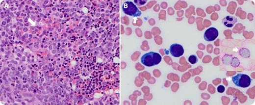 A 74-year-old man with relapsed refractory chronic lymphocytic leukemia (CLL) (treated with chemo-immunotherapy—purine analogs, cyclophosphamide, and rituximab) presented with acute-onset severe fatigue, anemia, hyperleukocytosis (62.3 K/µL), and low platelets (22 K/µL). The peripheral blood differential showed 8% atypical large cells. Bone marrow (BM) aspirates and biopsy were performed. / Panel A (×400 magnification hematoxylin and eosin) of the BM biopsy shows extensive sheets (90%) of immature large cells in a background of small lymphoid cells (arrow). Increased proerythroblasts (>25% in the touch preparation) with irregular nuclei, prominent nucleoli, and basophilic vacuolated cytoplasm were observed. Panel B demonstrates a Wright-Giemsa–stained marrow aspirate smear showing characteristic vacuolated pronormoblasts (arrows) and periodic acid-Schiff–positive cytoplasmic globules distributed in the periphery of the erythroid blasts (inset) (×1000 magnification). Periodic acid-Schiff positivity is a result of glycogen deposits in the erythroblasts. Immunohistochemistry and flow cytometry confirmed the CLL and E-cadherin–positive, glycophorin-negative erythroid blasts. Cytogenetic studies of BM showed complex karyotype. A final diagnosis of therapy-related, pure erythroid leukemia with a background of CLL was made. Initial clinical features with large cells in the BM mimicked Richter’s transformation. The patient died within a few days of the diagnosis as a result of progressive disease.