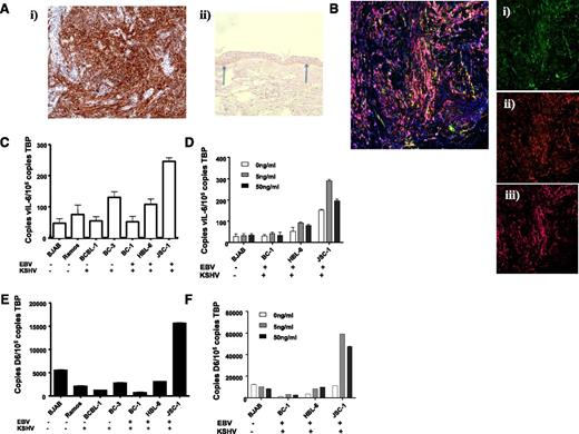 Figure 5. KSHV-related pathologies display high level of D6 expression. (Ai) KS tissue samples were stained for D6 immunoreactivity. D6 positivity is represented by the brown coloration and is seen throughout the tumor mass. (Aii) Staining for D6 immunoreactivity in healthy human skin confirming the specificity of staining by the antibody (basal keratinocyte staining indicated by arrows). (B) Costaining of a KS lesion for expression of D6, Lyve1, and podoplanin. Insets show (Bi) D6 (fluorescein isothiocyanate; green), (Bii) Lyve 1 (Texas Red; red), and (Biii) podoplanin (Alexa-647; purple). Complete overlap among all 3 markers leads to a pink coloration. (C) QPCR analysis of expression of vIL-6 in control and PEL cell lines. EBV and KSHV status is indicated below the graph. (D) QPCR analysis of expression of D6 in control and PEL cell lines. Again, EBV and KSHV status is indicated below the graph. (E) QPCR analysis of vIL-6 induction by phorbol ester at the indicated concentrations of TPA. (F) QPCR analysis of D6 expression in cell lines after phorbol ester treatment at the indicated concentrations of TPA.