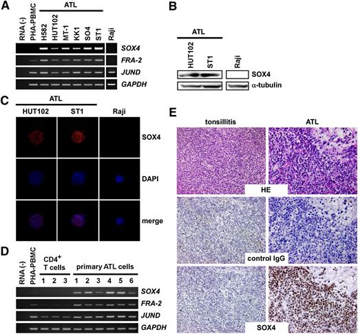 Figure 1. Expression of SOX4 in ATL. (A) RT-PCR analysis of ATL cell lines. Semiquantitative RT-PCR was performed to analyze expression of SOX4, FRA-2, and JUND in 6 ATL cell lines. Normal PBMCs treated with PHA for 3 days (PHA-PBMC) and Raji, a Burkitt lymphoma cell line, were also included. GAPDH was used as a loading control. The representative results from 3 separate experiments are shown. (B) Immunoblot analysis. Cell extracts prepared from 2 ATL cell lines and Raji were subjected to immunoblot analysis. After electrophoresis and electrotransfer, blotted filters were reacted with anti-SOX4 or anti–α-tubulin. The representative results from 3 separate experiments are shown. (C) Immunocytochemistry. Two ATL cell lines and Raji were used. Cells were fixed and stained with anti-SOX4 or control IgG. Cells were counterstained with DAPI. The representative results from 3 separate experiments are shown. Original magnification, ×800. (D) RT-PCR analysis of primary cells. Semiquantitative RT-PCR was performed to analyze expression of SOX4, FRA-2, and JUND in normal CD4+ T cells and primary ATL cells (>90% leukemia cells). GAPDH was used as a loading control. The representative results from 3 separate experiments are shown. (E) Immunohistochemistry. Tissue sections of inflamed tonsils (n = 2) and ATL skin lesions (n = 7) were stained with anti-SOX4 or control IgG. The representative results are shown. Original magnification, ×400. HE, hematoxylin-eosin; PHA, phytohemagglutinin.