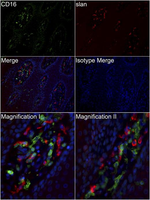 Figure 6. slanDCs in inflamed tissues mostly lack expression of CD16. Paraffin-embedded tissue sections (1 µm) of psoriatic plaques were immunostained for slan (red) and CD16 (green) or with appropriate isotype controls. Nuclei were counterstained with DAPI (blue). Upper four panels: original magnification ×200. Lower two panels: original magnification ×400. The slides were analyzed using a Leica DM 5500 B microscope and the MetaVue software. Data are representative for >10 experiments.