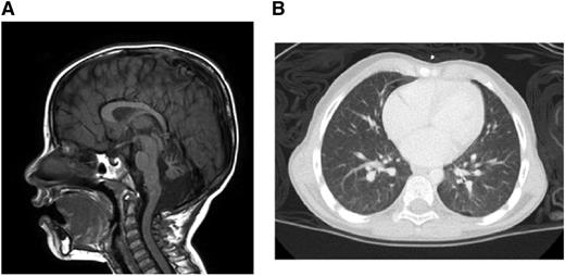 Figure 1. Clinical manifestations. (A) Brain magnetic resonance imaging. (B) Chest computed tomography.