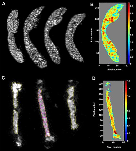 Figure 2. α-Camera imaging. (A) Cryosections (10 µm) of spleen imaged 3 hours after intravenous injection of 211At-B10-30F11. (B) The third section from the left in panel A was used for quantitative analysis of the activity distribution of 211At within the spleen. Each pixel intensity value (activity) was normalized to the mean pixel intensity of the whole spleen. The normalized data were divided in 10 bins (0 to max) and plotted as a color-coded histogram (1.0 = mean activity of the whole section). (C) Cryosections (10 µm) of femur imaged 3 hours after intravenous injection of 211At-B10-30F11. The large ROIs (yellow) outline the areas used for quantification of % ID/g in bone marrow by α-camera imaging. The small ROIs (magenta) in the middle femur image were used to compare the activity uptake (% ID/g) along the bone marrow cavity. (D) Quantitative histogram of 211At distribution of the middle femur section in panel C.