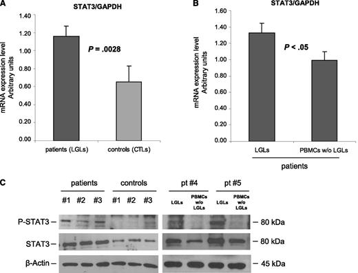 Figure 1. STAT3 expression analysis. (A-B) STAT3 mRNA expression average (± SE) obtained by RT-PCR and normalized on GAPDH. Panel A reports results from patients’ LGLs (n = 27) compared with control participants’ CTL cells (n = 18). Panel B represents patients’ LGLs compared with autologous PBMCs depleted of LGLs (n = 10). The average differences were statistically significant (P = .0028 and P < .05, respectively). (C) Evaluation of P-STAT3 and total STAT3 by western blot analysis. β-Actin served as a loading control. Representative cases for patients’ LGLs, control participants’ CTLs, and autologous LGL-depleted PBMCs (patients #4 and #5) are reported.