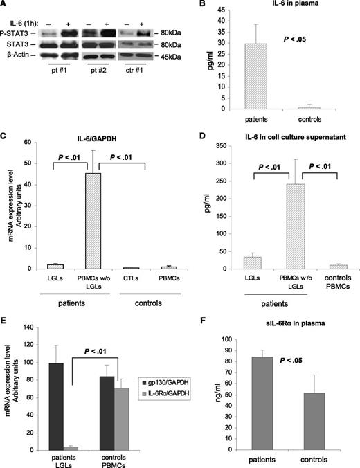 Figure 2. IL-6 effect on P-STAT3 and expression and release of IL-6 and its receptors. (A) Evaluation by western blot analysis of P-STAT3 and STAT3 in cell extracts after 1 hour of incubation with or without IL-6 at 10 ng/mL. β-Actin served as a loading control. P-STAT3 increases with IL-6 both in patients and in control participants. (B) Histograms of IL-6 levels in the plasma of patients and control participants measured by the ELISA test. (C) IL-6 mRNA expression and (D) secretion levels in patients (LGLs and LGL-depleted PBMCs, n = 27) and in control participants (CTLs and PBMCs, n = 18). (E) Histograms of IL-6Rα and gp130 mRNA expression levels in patients (LGLs) and in control participants (PBMCs). (F) Histograms of the secreted form of IL-6Rα in plasma measured by the ELISA test. All results are expressed as mean ± SE.