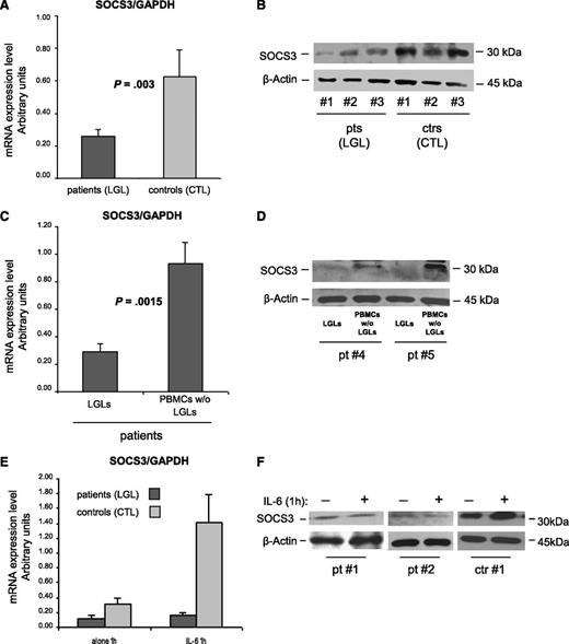 Figure 4. SOCS3 expression analysis. (A-D) SOCS3 expression average (± SE) obtained by RT-PCR and normalized on GAPDH and western blot analysis of cell extracts for SOCS3 in 3 representative patients (LGLs) and 3 control participants (CTLs). β-Actin served as a loading control. Panel A and B report results from patients’ LGLs (n = 27) compared with control participants’ CTLs (n = 18). Panel C and D report data from patients’ LGLs compared with autologous LGL-depleted PBMCs. The differences were statistically significant (panel A, P = .003 and panel C, P = .0015). (E) Mean results (± SE) of SOCS3 mRNA expression and (F) protein level in 2 representative patients and 1 control participant obtained by cells after culture in medium alone or medium with IL-6 for 1 hour.