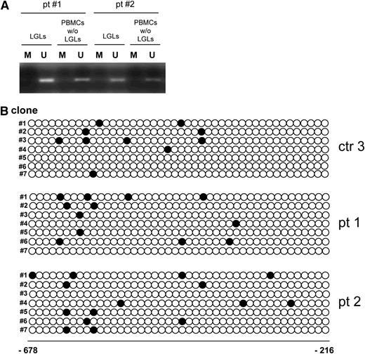 Figure 6. Methylation of SOCS3 promoter. (A) Methylation-specific PCR of the SOCS3 promoter in LGLs and the autologous LGL-depleted PBMCs of 2 representative patients. M: methylated band and U: unmethylated band. (B) Methylation of CpG dinucleotides. The figure reports the methylation pattern in the promoter region of the SOCS3 gene for 1 representative control participant and 2 representative patients. The filled circles indicate methylated CpG dinucleotides, and the empty circles indicate unmethylated dinucleotides. The numbers indicate the CpG dinucleotide position before the start codon. Analysis of the control participants was performed on the sorted CTLs; in the patients, the analysis was performed on the sorted LGLs. The methylation frequency, for each sequenced clone, was calculated as the number of methylated CpG dinucleotides over the total CpG dinucleotides present in the analyzed sequence. The difference in median methylation frequency was similar both in the patients and in the control participants.