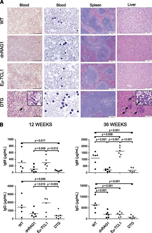 Figure 2. DTG mice show evidence of CLL-like disease and hypogammaglobulinemia at 36 weeks. (A) Blood smears were developed with Wright-Giemsa stain. Images (×200 and ×600) were acquired using Nikon Eclipse E400 microscope (Nikon, Melville, NY) and Optronics camera running MagnaFire software (Optronics, Goleta, CA). Paraffin-embedded spleen and kidney sections were developed with hematoxylin and eosin. Images (×100 for spleen and ×200 for liver) were acquired using a Nikon i80 microscope and DigiFire camera running ImageSys digital imaging software (Soft Imaging Systems GmBH, Munster, Germany). DTG mice at this age show peripheral blood lymphocytosis with frequent occurrence of smudge cells (arrow, see inset), loss of splenic architecture, and infiltration of leukemic cells in liver (arrows). Scale bars: blood and liver, 100μM; spleen, 200μM. (B) Serum IgM and IgG levels were measured by enzyme-linked immunosorbent assay for groups of 12- and 36-week-old WT, dnRAG1, Eμ-TCL1, and DTG mice. Individual values and means (indicated by horizontal bar) are shown for each group; statistically significant differences between groups are indicated.