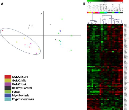 Figure 5. GATA2 patients have unique transcript profiles compared with healthy normals and diseased controls. Normalized transcript counts from nCounter analysis used for (A) 2-dimensional principal component analysis of patients with GATA2 i5C>T (patients 4.II.1, 11.II.1, 25.I.1), missense mutation (GATA2 Mis; patients 15.I.1, 19.II.1, 30.II.1), and reduced allelic expression without identified GATA2 mutation (GATA2 Unk; patients 7.I.1, 29.I.1) compared with healthy controls and diseased controls with similar infection types but wild-type GATA2. Fungal, disseminated coccidioidomycosis or histoplasmosis; Mycobacteria, disseminated mycobacteria; Cryptosporidiosis, disseminated cryptosporidium. (B) Hierarchical clustering of transcripts differentially regulated (P < .05) between healthy normals and GATA2 mutated patients irrespective of genotype. Samples and color labels correspond to mutations as in A.