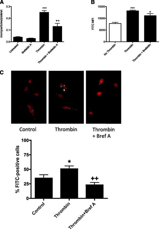Figure 4. miRNA is transferred to endothelial cells by a vesicle-dependent mechanism. (A) The effect of brefeldin A on platelet microparticle release was assessed with flow cytometry. Brefeldin A (10 μg/mL) was added to platelet-rich plasma 30 minutes before the addition of 1 U/mL thrombin. The microparticle population was defined based on size and expression of CD42a. ***P < .001 comparing untreated with thrombin-stimulated, ++P < .01 comparing thrombin vs thrombin + brefeldin A, n = 3. (B) Mean fluorescence in the FL1 channel within the microparticle population was used to assess miR-Scr-FITC content (***P < .001 comparing no thrombin vs thrombin-stimulated; +P < .05 comparing thrombin versus thrombin + brefeldin A, n = 6). (C) Quantification of FITC-labeled miRNA in HMEC-1 cells. Pixels of intensity greater than background staining were pseudocolored white. In each image the percentage of cells positive for white pixels were counted manually (*P < .05 comparing HMEC-1 cells cocultured with platelets in the presence or absence of thrombin; ++P < .01 comparing HMEC-1 cells cocultured with platelets in the presence of thrombin alone or with brefeldin A).
