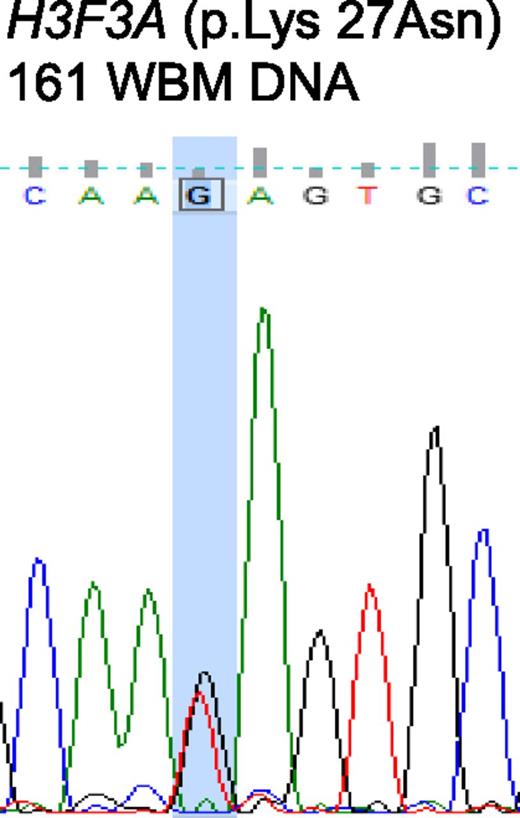 Figure 1. Sanger sequencing chromatogram depicting a mutation of H3F3A at amino acid 27, resulting in a replacement of lysine by asparagine (K27N). Mutations are marked by the column (G > T).