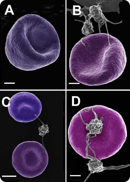 Throughout a healthy pregnancy, there is a general elevation of hemostatic activation markers, and research has shown that platelet activation contributes to a general hypercoagulable state. Here, we studied healthy individuals during early and late pregnancy and also postpartum. There were 30 females per group, and they did not smoke or take any medication before or during their pregnancy. Red blood cell (RBC) and platelet ultrastructure were studied using blood smears and scanning electron microscopy to determine if there is a changed ultrastructure during a healthy pregnancy. Blood smears show a typical RBC from a female of childbearing age, typically with no platelet association (panel A, bar represents 1 μm), and RBCs during early and late pregnancy, as well as 6 to 8 weeks postpartum (panels B-D, respectively; bars represent 1 μm). During these 3 stages, almost all RBCs in the whole blood smears were closely associated with platelets, showing platelet spreading and pseudopodia closely associated with RBC membranes. Although, in all samples, 1 RBC is typically involved with only 1 platelet, we have noted that a single platelet may have multiple interactions with RBCs (panel C). / Here we suggest that these interactions between RBCs and platelets may be one of the reasons for an increased hypercoagulability during a healthy pregnancy, and this state continues for a while postpartum. Thus, these RBC/platelet interactions could possibly contribute to gestational thrombocytopenia.