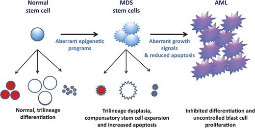 Figure 2. A model of MDS formation and progression. It is hypothesized that the altered differentiation programs and dysplasias pathognomonic of MDS are due to aberrant epigenetic regulation (summarized in Figure 1). These differentiation defects signal compensatory stem cell growth but also result in increased apoptosis, which explains the paradox of hypercellular marrows but peripheral cytopenias in MDS. With time, MDS cells acquire mutations that confer uncontrolled growth signals (eg, NRAS) and/or inhibited apoptosis (eg, P53). These mutations (and, possibly additional epigenetic defects) lead to the blast expansion and inhibited differentiation characteristic of the transition from MDS to AML.