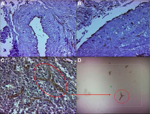 Figure 1. Representative example of the LM technique for the isolation of mature ECs from the spleen. (A-B) The photomicrographs showing the ECs of the luminal surface of the splenic vein of patients 6 and 9, respectively, after immunohistochemical staining with anti-CD34 mAb and counterstaining with Harris hematoxylin. (C-D) Capillary of the splenic pulp immunostained with anti-CD34 mAb (as in panels A and B) before (C) and after (D) being laser microdissected and catapulted into the cap of a PCR tube. Original magnification for panels A, B, and C was 40× and for panel D, 10× using LD-Arcoplan objectives. The microdissection laser system is equipped on an inverted microscope (Axiovert 200; Zeiss) linked to a Sony DXC-309F 3CCD color video camera.