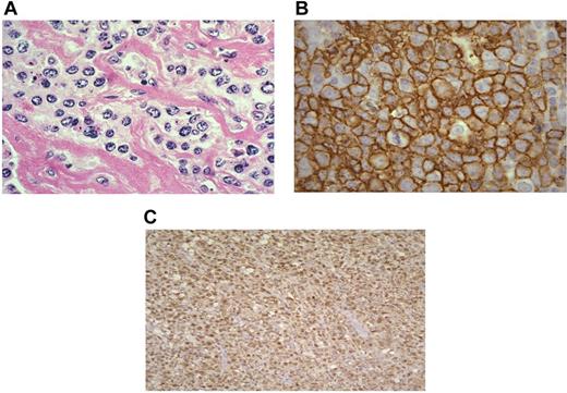 Figure 2. Pathologic features of mediastinal large-cell lymphoma. (A) H&E histologic section of a MLBL tumor showing the characteristic large-cell infiltrate with intervening bands of compartmentalizing fibrosis. The tumor cells form individual cells and small groups (400× magnification). (B) CD20 immunoperoxidase staining demonstrating the mature MLBL infiltrate (1000× magnification). (C) IRF4/MUM 1 staining of a MLBL tumor showing characteristic nuclear staining (100× magnification; Olympus BX40 microscope).