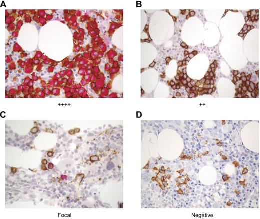 Figure 5. WT1 is expressed in CD138+ plasma cells in the BM of MM patients. The expression of WT1 in MM cells was longitudinally assessed over the course of disease in MM patients before and after alloTCD-HSCT and DLI. Paraffin-fixed BM biopsies from MM patients were double stained with monoclonal antibodies to CD138 (MI15; DAB, brown) and WT1 (6F-H2; nFu, red). Immunohistochemical analysis of WT1 expression was performed and biopsies were graded negative, focal, +, ++, +++, or ++++ based on the percentage of CD138+ PC staining positive for WT1. Representative biopsy stains are shown. (A) ++++ > 75% of CD138+ PC stain positive for WT1; UPN5. (B) ++ > 25%-30% of CD138+ cells are WT1+; UPN10. (C) Focal < 5% of CD138+ cells are WT1+; UPN10. (D) Negative, no CD138+ are positive for WT1; UPN10 (20×).