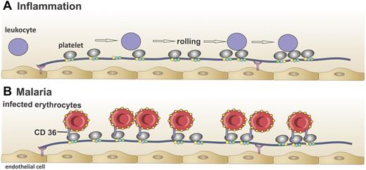 Figure 3. Interaction of platelet-decorated VWF strings with leukocytes and infected red blood cells in vitro. (A) Leukocytes (purple circles) interact with platelet-decorated VWF strings in vitro in the absence of ADAMTS13,51 which results in rolling of leukocytes over the VWF string, suggesting that VWF strings in the absence of ADAMTS13 can contribute to inflammation. (B) Red blood cells infected with the malaria parasite P falciparum (red circles) adhere to platelet-decorated VWF strings via the platelet receptor CD36 in vitro in the absence of ADAMTS13.85 This mechanism might explain binding of infected red blood cells to the brain endothelium in cerebral malaria.