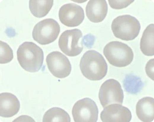 A 5-year-old girl was treated for 4 years based on a diagnosis of immune thrombocytopenia (ITP). When she presented for a second opinion, she met all criteria for ITP except that inspection of her peripheral blood smear showed large platelets with a complete lack of granulation, indicating a diagnosis of gray platelet syndrome (GPS). Electron microscopy subsequently showed absence of α-granules. / The name GPS comes from the gray appearance of the platelets in the peripheral blood smear as a result of the absence of α-granules. The genetic basis of GPS was recently demonstrated to be due to mutations in NBEAL2. The NBEAL2 gene encodes for the neurobeachin-like 2 (NBEAL2) protein, which is a member of the family of BEACH (BEige And Chediak-Higashi) domain-containing proteins on chromosome 3 (3p21). The NBEAL2 protein is likely involved in vesicular trafficking and may be critical for the development of α-granules. Patients with GPS have a life-long predisposition to mucocutaneous bleeding and are also predisposed to develop myelofibrosis. This case illustrates the importance of inspection of the blood smear before making a diagnosis of ITP.