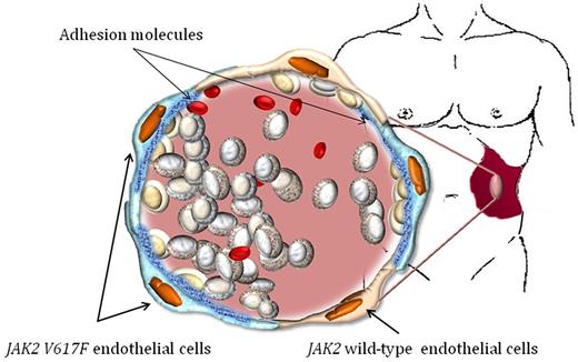 In myelofibrosis, both angiogenesis and myeloproliferation constitute the expression of neoplastic growth. A significant proportion of endothelial cells lining the spleen microvasculature harbors the JAK2V617F mutation. The figure illustrates how mutated endothelial cells, producing abnormally high levels of adhesion molecules such as ICAM-1, V-CAM, and E-selectin, might represent the “neoplastic” vascular niches where trapped hematopoietic stem cells are forced to proliferate. Indeed, in spleen microenvironment, neoplastic myeloproliferation and angiogenesis are tightly interrelated.