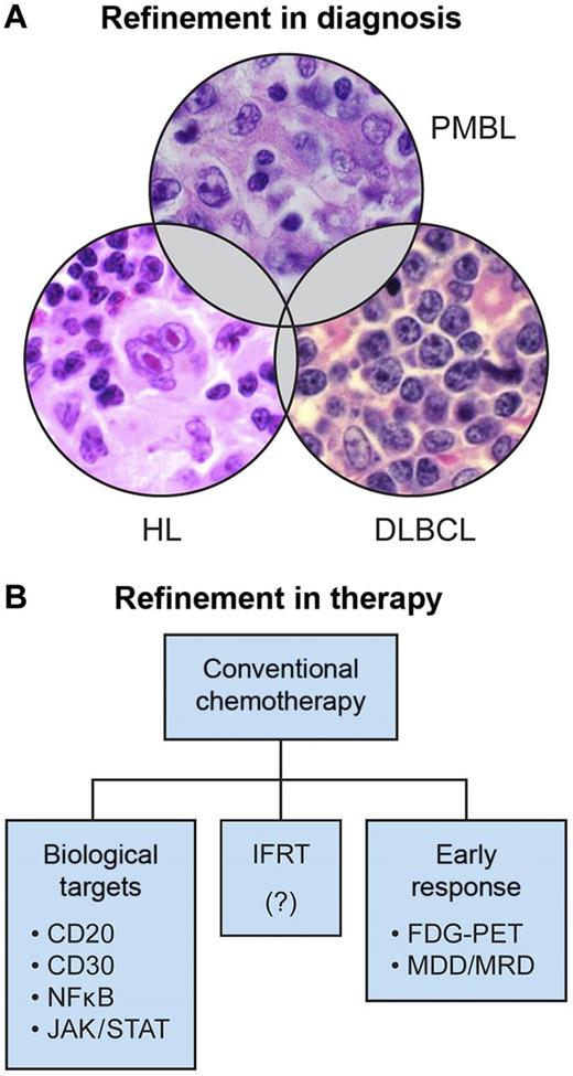 (A) Refinement in diagnosis. Among cases of MLBL, the histologic distinction between PMBL, DLBCL and HL may be difficult. (B) Refinement in therapy may include the incorporation of novel biologic targeting agents, involved field radiation, and improved methods of measurement of early response to therapy. MLBL indicates mediastinal large B-cell lymphoma; PMBL, primary mediastinal large B-cell lymphoma; HL, Hodgkin lymphoma; DLBCL, diffuse large B-cell lymphoma; IFRT, involved field radiation therapy; MDD, minimal disseminated disease; and MRD, minimal residual disease.