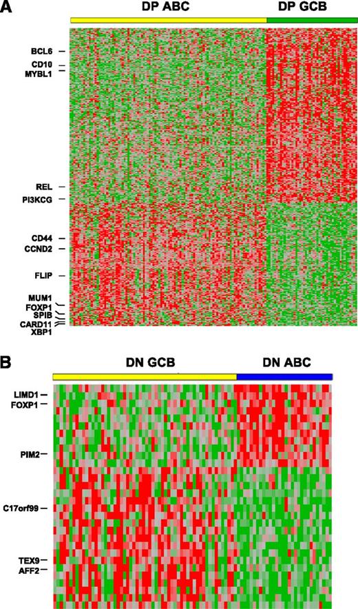 Figure 6. MYC/BCL2 coexpression contributes to the different gene expression profiles between GCB and ABC subtypes of DLBCL. (A) GEP comparison between the ABC vs GCB subtype of DLBCL with MYC/BCL2 coexpression. Of 157 cases of MYC+BCL2+ DLBCL, GEP was successfully performed in 149 cases (ABC: 102; GCB: 47). DP, MYC/BCL2 double positive. A total of 208 genes corresponding to 365 probe sets were differentially expressed (P < .001). (B) GEP comparison between the ABC (30 cases) vs GCB (58 cases) subtype of DLBCL negative for both MYC and BCL2 protein expression. A total of 20 genes corresponding to 30 probesets were differentially expressed between the 2 COO subtypes (P < .01). DN, MYC/BCL2 double negative.